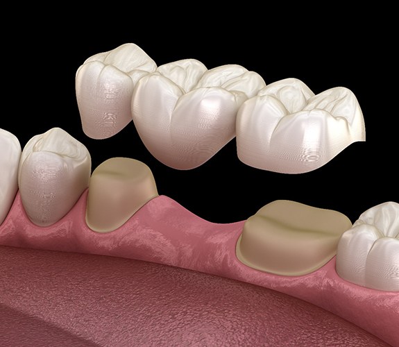 A dental bridge