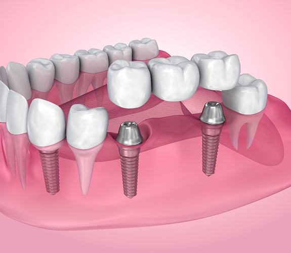 A digital image of an implant bridge