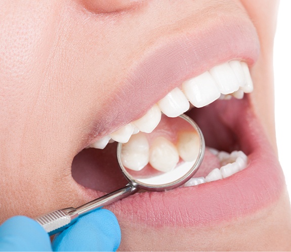 Dentist examining patient's smile after metal free dental restoration