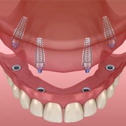 Implant dentures   