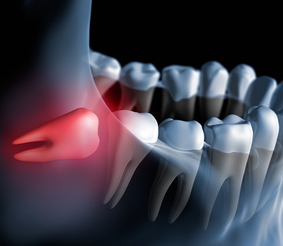 Animated smile with impacted tooth before tooth extractions