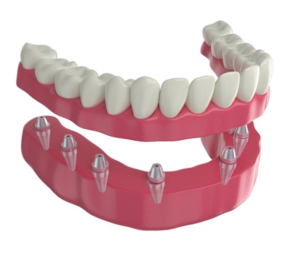 Digital image of implant dentures 