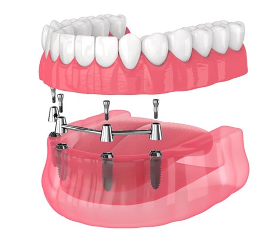 Digital implant of a removable implant denture  