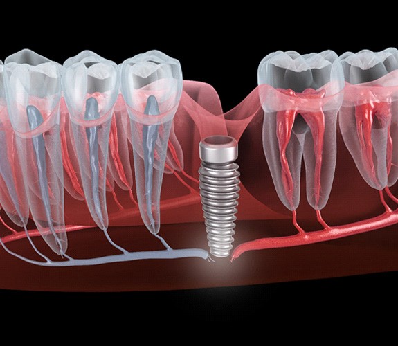 Failed dental implant