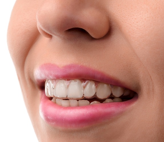 Closeup of smile with Clear Aligners tray in place