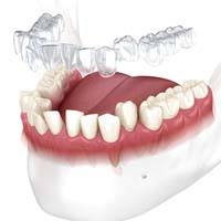 Invisalign aligner in Franklin Park