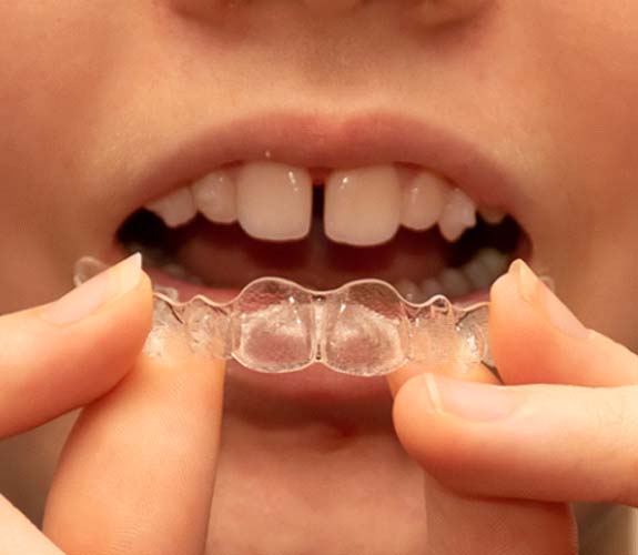 Invisalign Teen in Franklin Park