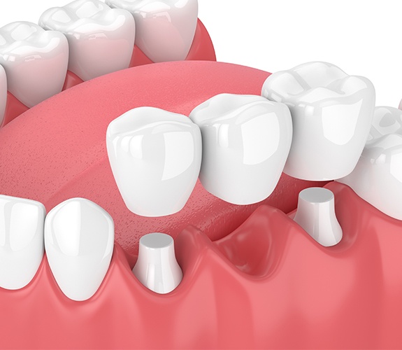 Animated smile with dental bridge tooth replacement