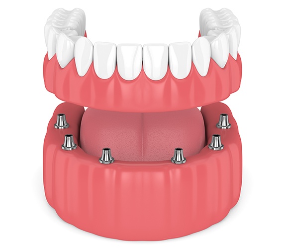 Aniamted dental implant supported denture placement