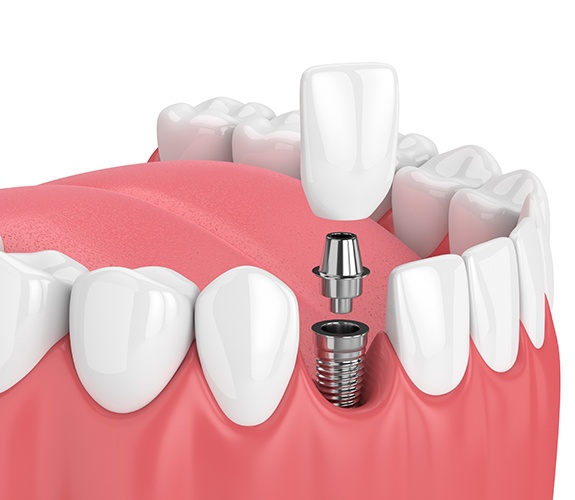 Animated dental implant supported dental crown placement