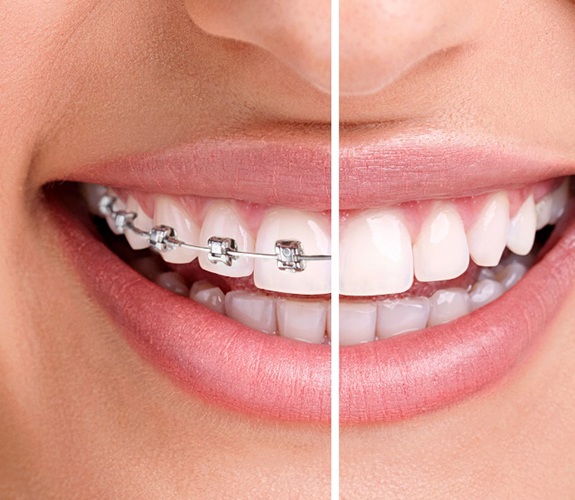 Before and after of woman wearing braces in Franklin Park, IL