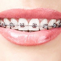 Close-up of woman wearing braces in Franklin Park, IL