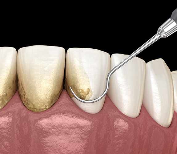 Animated smile during scaling and root planing gum disease treatment