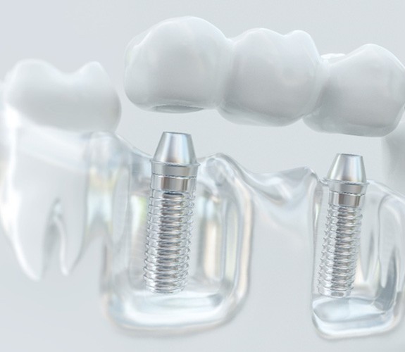 How dental implants work in Franklin Park 