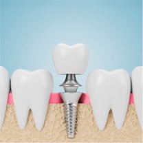 Dental implant in Franklin Park 