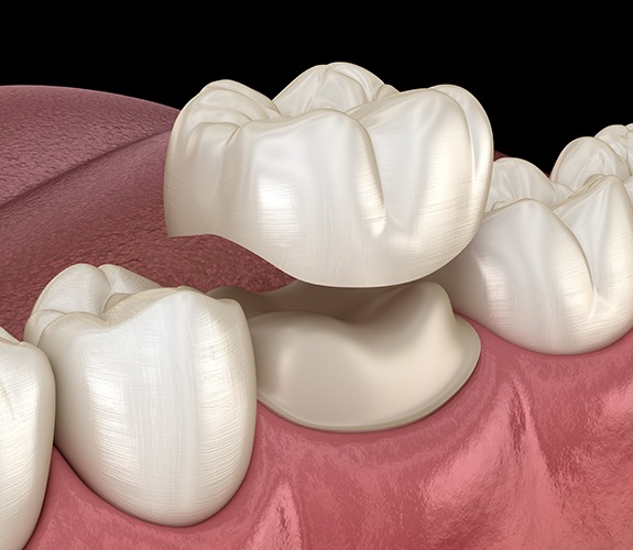 Animated dental crown placement