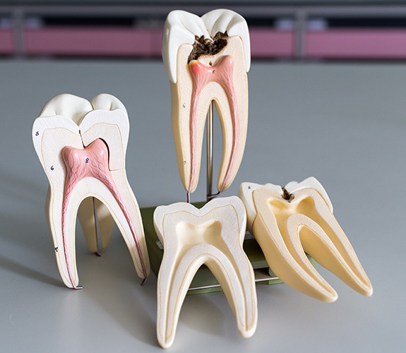 Models of teeth at various stages of root canal treatment