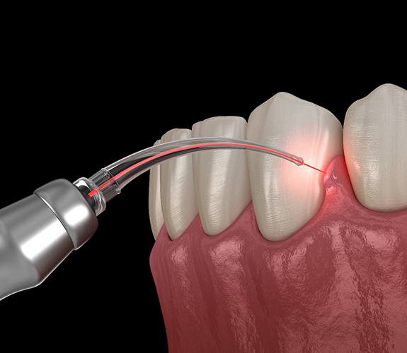 Close-up illustration of soft tissue laser dentistry in Franklin Park