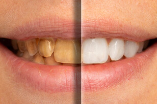 before and after teeth whitening