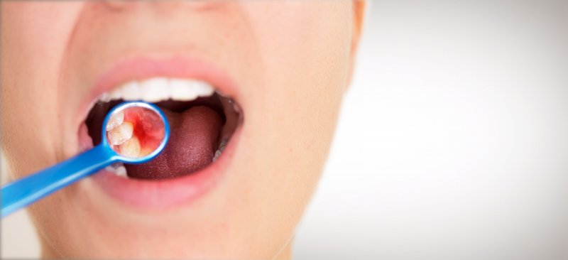 Dentist checking female patient’s red, swollen gums