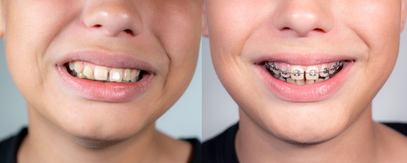 Before and after pictures of child getting braces for overbite