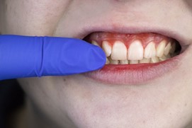 patient with gum disease in Franklin Park