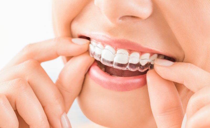 woman inserting Invisalign aligner