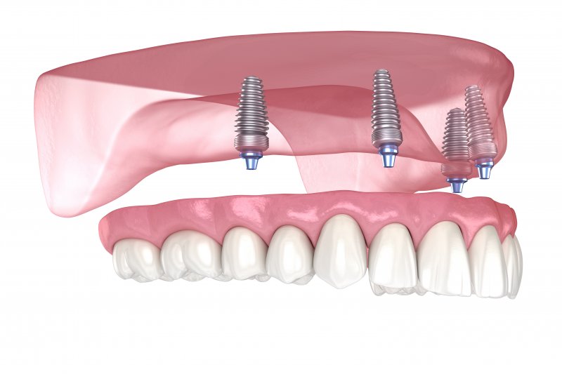 digital image of an implant denture