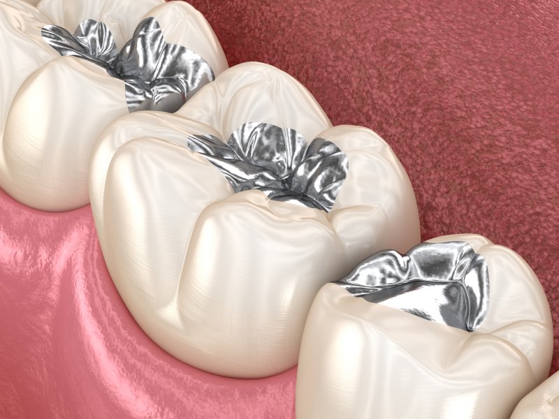 digital image of teeth with metal fillings