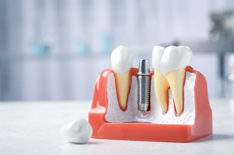 mouth mold and titanium dental implant